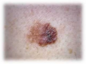 melanoma