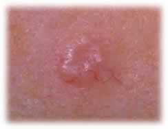 skin-cancer-bcc