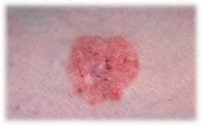 skin-cancer-scc