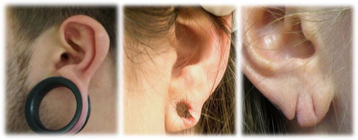 Torn and stretched ear lobe repairs - Kingsley Medical