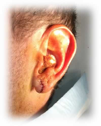 Ear sales lobe stretcher