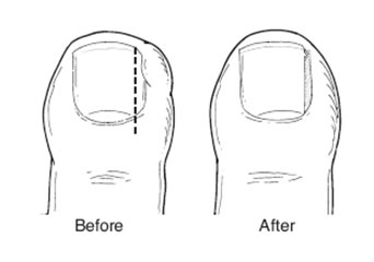 Ingrown toenails/wedge resections - Kingsley Medical | More than your ...